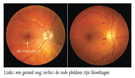 Gezond oog en een ongezond oog